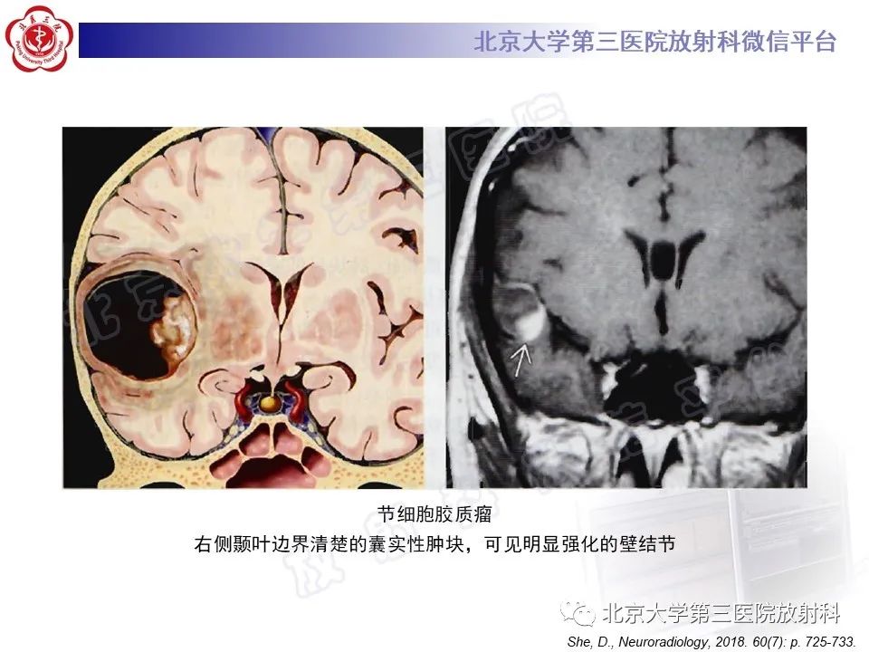 影像PPT - 【PPT】少突胶质细胞瘤-30