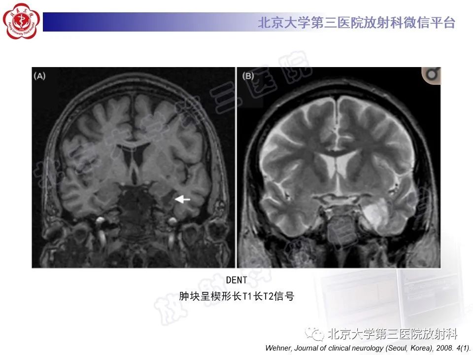 影像PPT - 【PPT】少突胶质细胞瘤-32