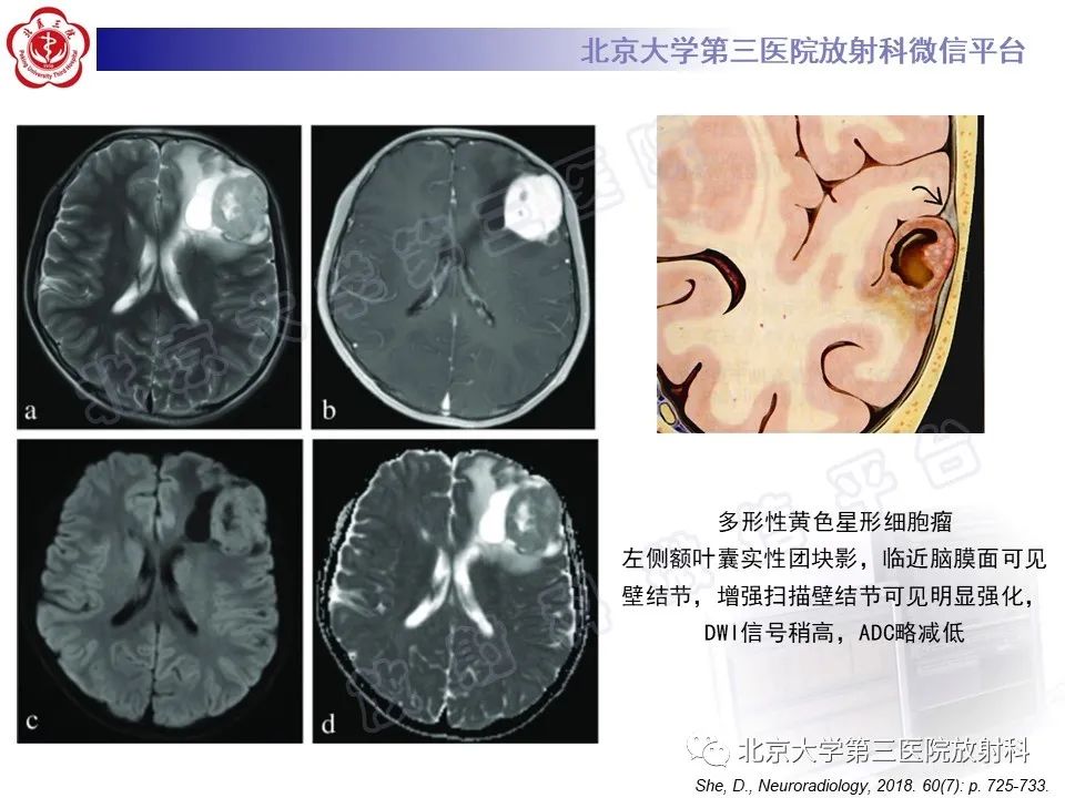 影像PPT - 【PPT】少突胶质细胞瘤-34