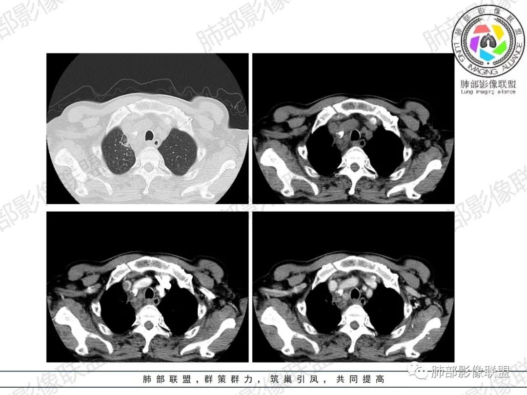 影像PPT - 【病例】HIV相关,肿瘤还是感染?-7 影像PPT - 【病例】HIV相关,肿瘤还是感染?-7