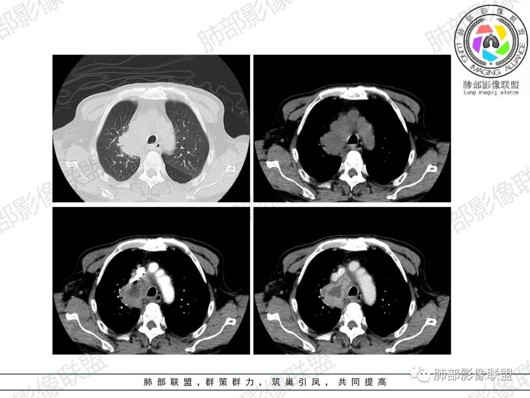 影像PPT - 【病例】HIV相关,肿瘤还是感染?-10 影像PPT - 【病例】HIV相关,肿瘤还是感染?-10