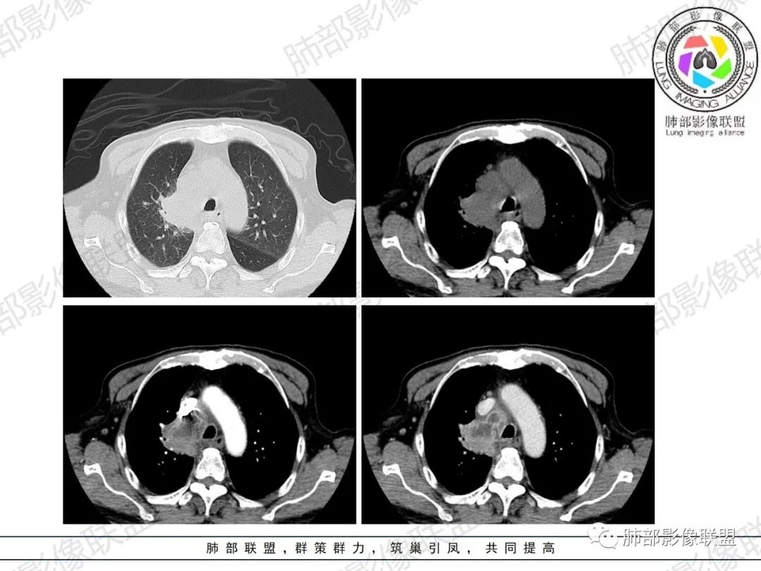 影像PPT - 【病例】HIV相关,肿瘤还是感染?-11 影像PPT - 【病例】HIV相关,肿瘤还是感染?-11