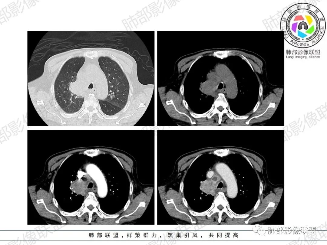 影像PPT - 【病例】HIV相关,肿瘤还是感染?-12 影像PPT - 【病例】HIV相关,肿瘤还是感染?-12