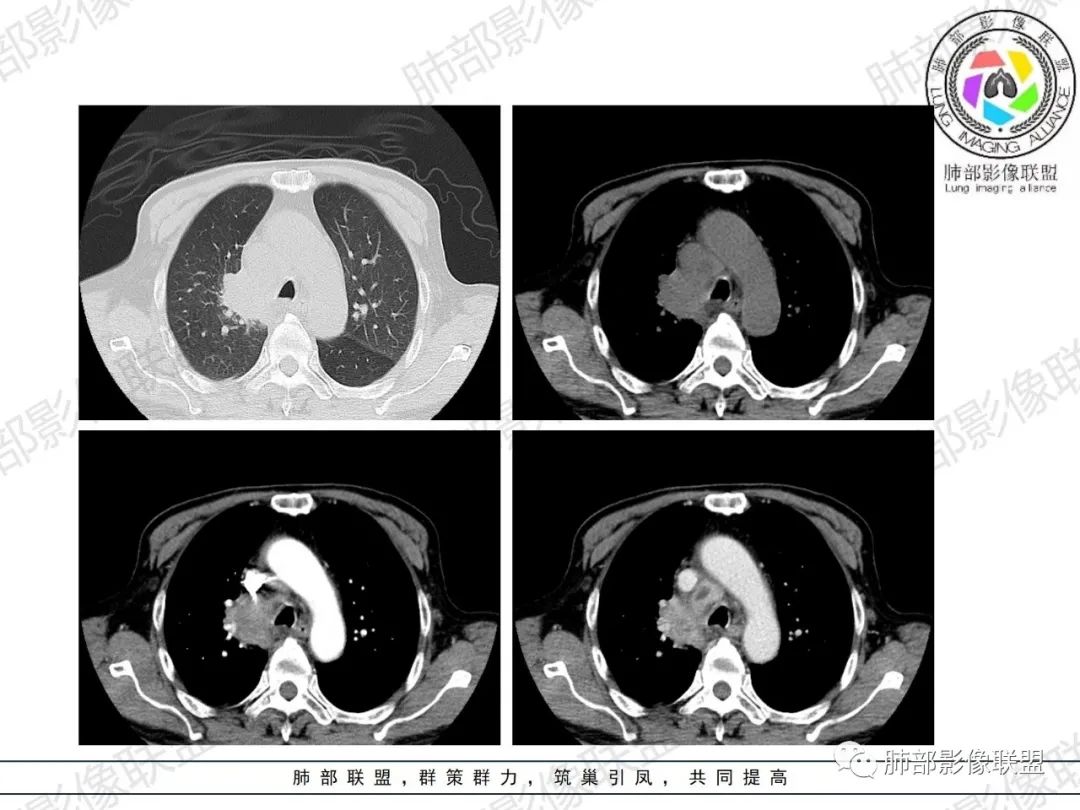 影像PPT - 【病例】HIV相关,肿瘤还是感染?-13 影像PPT - 【病例】HIV相关,肿瘤还是感染?-13