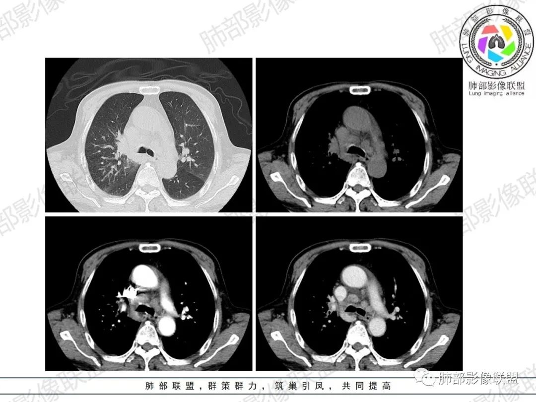 影像PPT - 【病例】HIV相关,肿瘤还是感染?-15 影像PPT - 【病例】HIV相关,肿瘤还是感染?-15