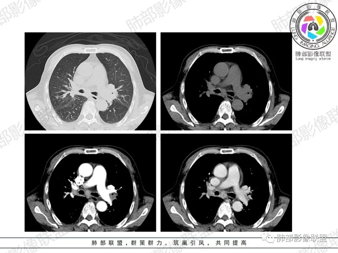 影像PPT - 【病例】HIV相关,肿瘤还是感染?-16 影像PPT - 【病例】HIV相关,肿瘤还是感染?-16