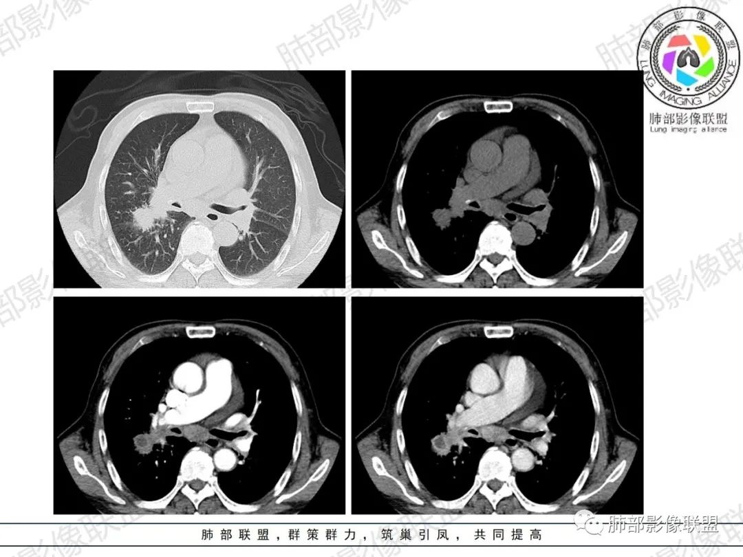 影像PPT - 【病例】HIV相关,肿瘤还是感染?-17 影像PPT - 【病例】HIV相关,肿瘤还是感染?-17