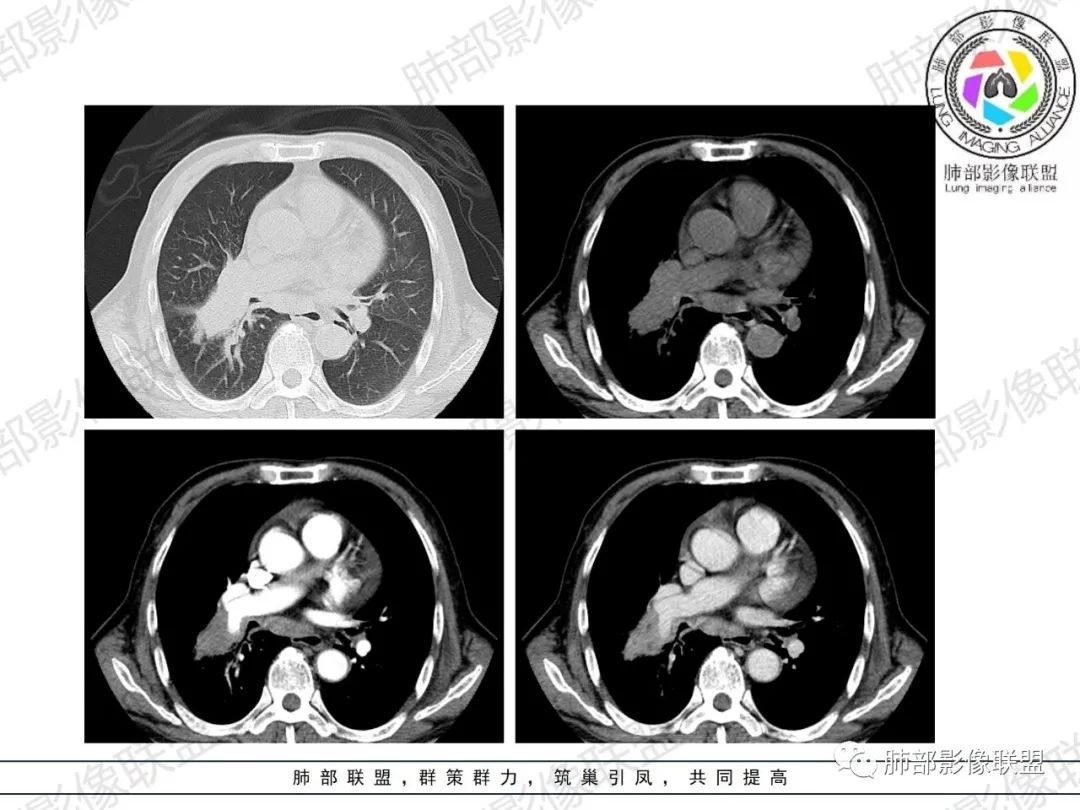 影像PPT - 【病例】HIV相关,肿瘤还是感染?-19 影像PPT - 【病例】HIV相关,肿瘤还是感染?-19