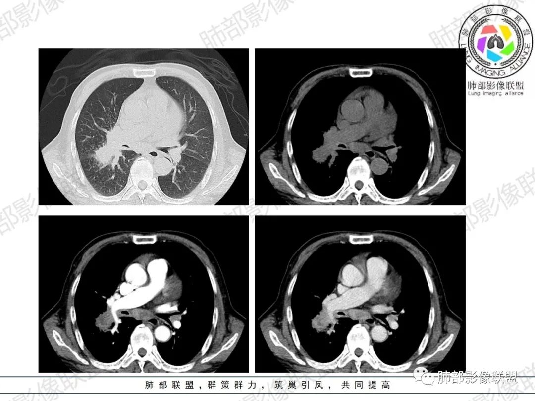 影像PPT - 【病例】HIV相关,肿瘤还是感染?-18 影像PPT - 【病例】HIV相关,肿瘤还是感染?-18