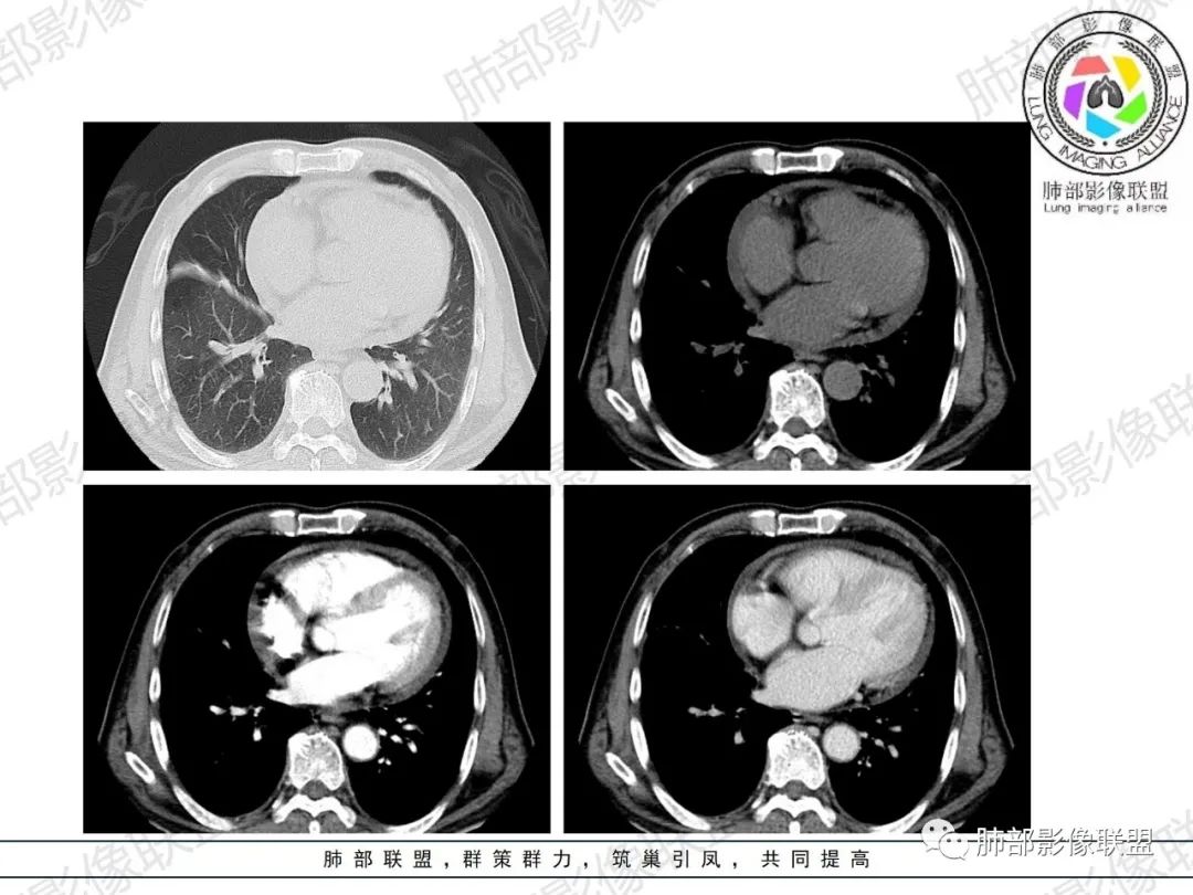 影像PPT - 【病例】HIV相关,肿瘤还是感染?-21 影像PPT - 【病例】HIV相关,肿瘤还是感染?-21