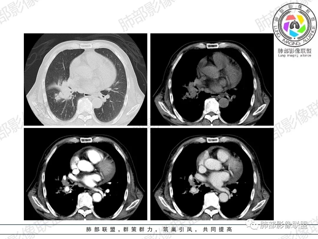 影像PPT - 【病例】HIV相关,肿瘤还是感染?-20 影像PPT - 【病例】HIV相关,肿瘤还是感染?-20