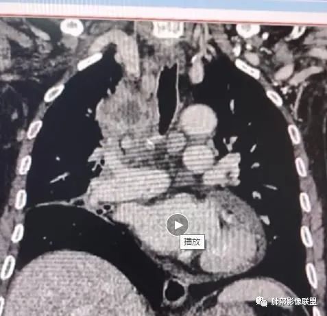 影像PPT - 【病例】HIV相关,肿瘤还是感染?-31 影像PPT - 【病例】HIV相关,肿瘤还是感染?-31