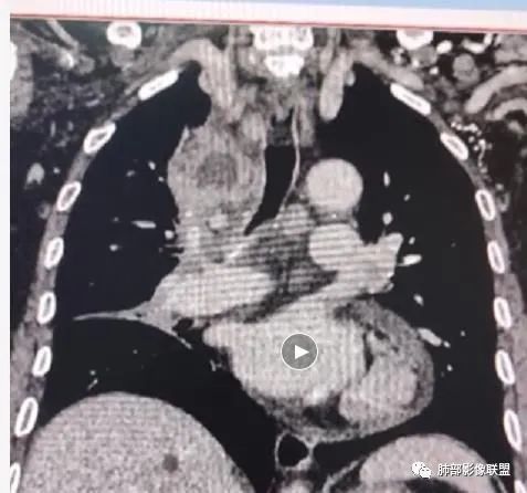影像PPT - 【病例】HIV相关,肿瘤还是感染?-32 影像PPT - 【病例】HIV相关,肿瘤还是感染?-32
