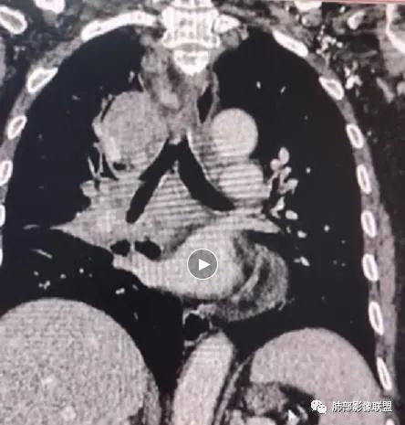 影像PPT - 【病例】HIV相关,肿瘤还是感染?-34 影像PPT - 【病例】HIV相关,肿瘤还是感染?-34