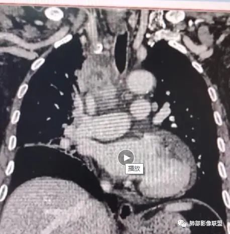 影像PPT - 【病例】HIV相关,肿瘤还是感染?-30 影像PPT - 【病例】HIV相关,肿瘤还是感染?-30