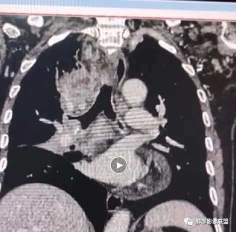 影像PPT - 【病例】HIV相关,肿瘤还是感染?-33 影像PPT - 【病例】HIV相关,肿瘤还是感染?-33