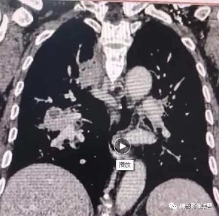 影像PPT - 【病例】HIV相关,肿瘤还是感染?-35 影像PPT - 【病例】HIV相关,肿瘤还是感染?-35