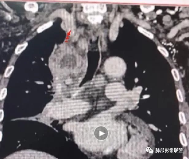 影像PPT - 【病例】HIV相关,肿瘤还是感染?-38 影像PPT - 【病例】HIV相关,肿瘤还是感染?-38