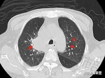 影像PPT - 【病例】HIV相关,肿瘤还是感染?-36 影像PPT - 【病例】HIV相关,肿瘤还是感染?-36