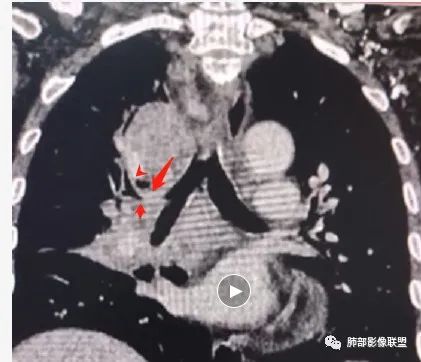 影像PPT - 【病例】HIV相关,肿瘤还是感染?-43 影像PPT - 【病例】HIV相关,肿瘤还是感染?-43