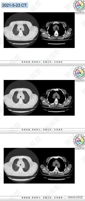 影像PPT - 【病例】HIV相关,肿瘤还是感染?-47 影像PPT - 【病例】HIV相关,肿瘤还是感染?-47