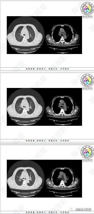 影像PPT - 【病例】HIV相关,肿瘤还是感染?-49 影像PPT - 【病例】HIV相关,肿瘤还是感染?-49