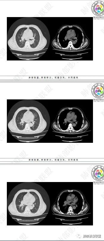 影像PPT - 【病例】HIV相关,肿瘤还是感染?-51 影像PPT - 【病例】HIV相关,肿瘤还是感染?-51
