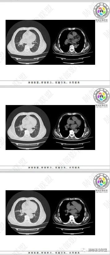 影像PPT - 【病例】HIV相关,肿瘤还是感染?-52 影像PPT - 【病例】HIV相关,肿瘤还是感染?-52