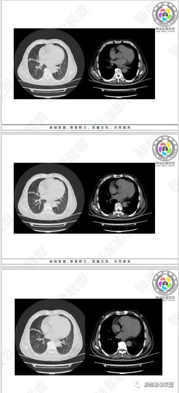 影像PPT - 【病例】HIV相关,肿瘤还是感染?-53 影像PPT - 【病例】HIV相关,肿瘤还是感染?-53
