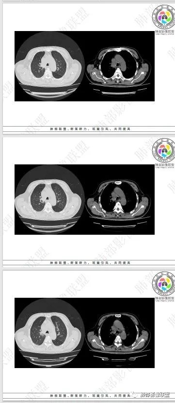 影像PPT - 【病例】HIV相关,肿瘤还是感染?-48 影像PPT - 【病例】HIV相关,肿瘤还是感染?-48