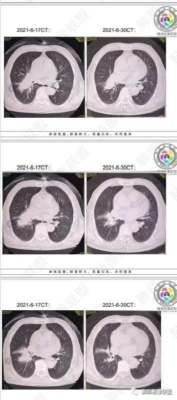 影像PPT - 【病例】HIV相关,肿瘤还是感染?-57 影像PPT - 【病例】HIV相关,肿瘤还是感染?-57