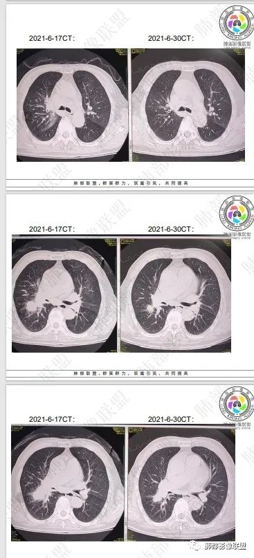 影像PPT - 【病例】HIV相关,肿瘤还是感染?-56 影像PPT - 【病例】HIV相关,肿瘤还是感染?-56