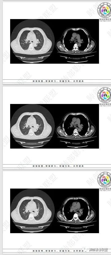 影像PPT - 【病例】HIV相关,肿瘤还是感染?-50 影像PPT - 【病例】HIV相关,肿瘤还是感染?-50