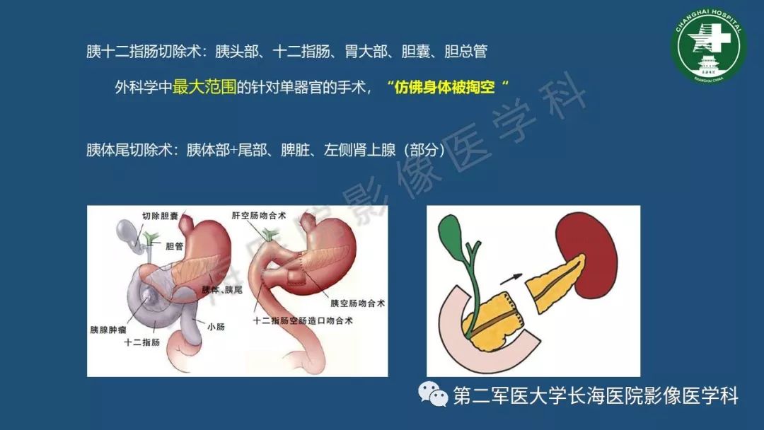 影像PPT - 【PPT】胰腺影像诊断在临床决策中的意义及常见误诊病种-2