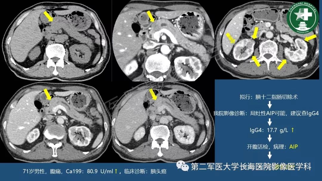 影像PPT - 【PPT】胰腺影像诊断在临床决策中的意义及常见误诊病种-5