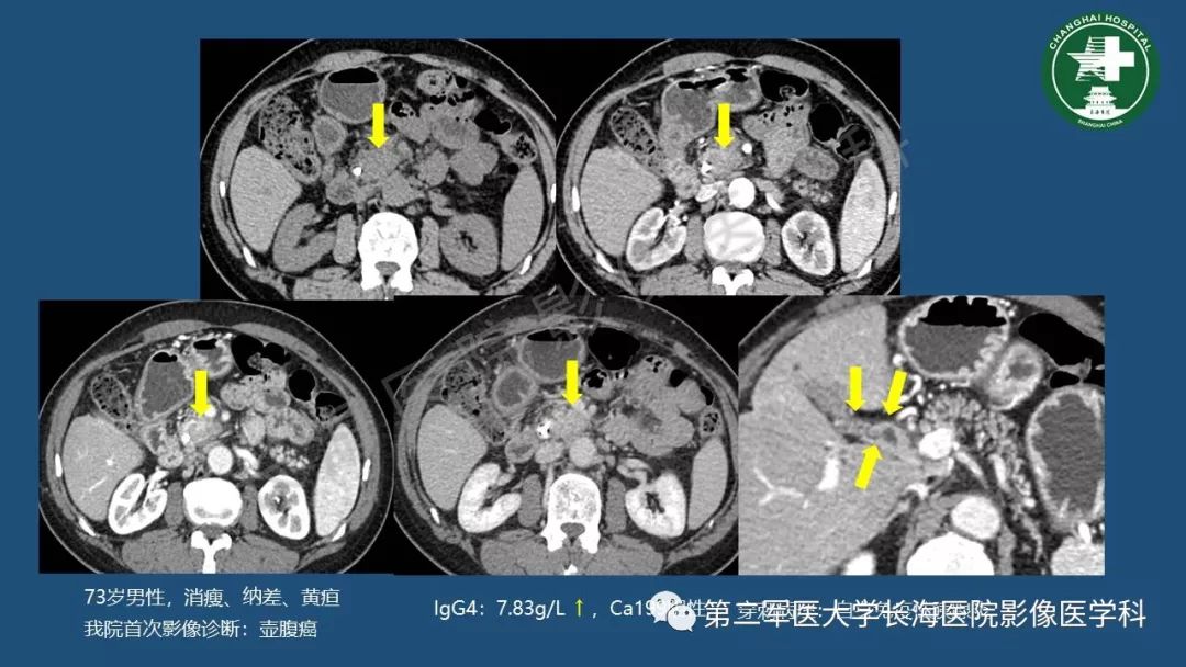 影像PPT - 【PPT】胰腺影像诊断在临床决策中的意义及常见误诊病种-6