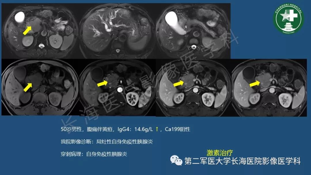 影像PPT - 【PPT】胰腺影像诊断在临床决策中的意义及常见误诊病种-7