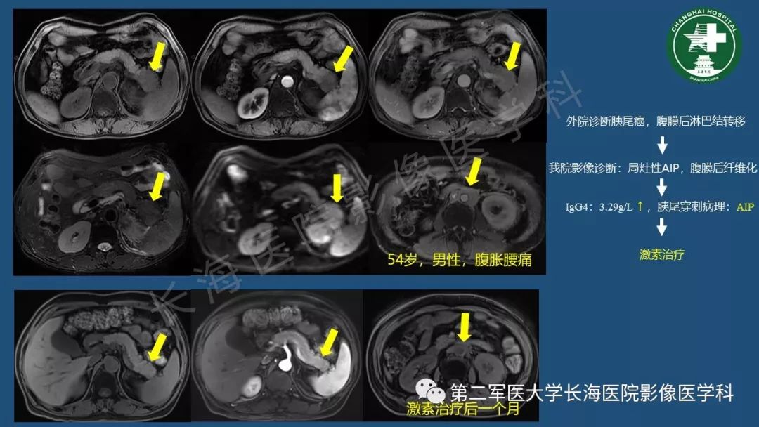 影像PPT - 【PPT】胰腺影像诊断在临床决策中的意义及常见误诊病种-8