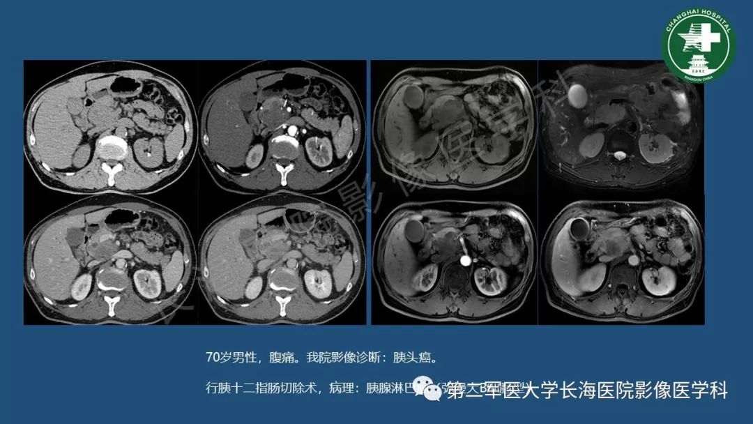 影像PPT - 【PPT】胰腺影像诊断在临床决策中的意义及常见误诊病种-10