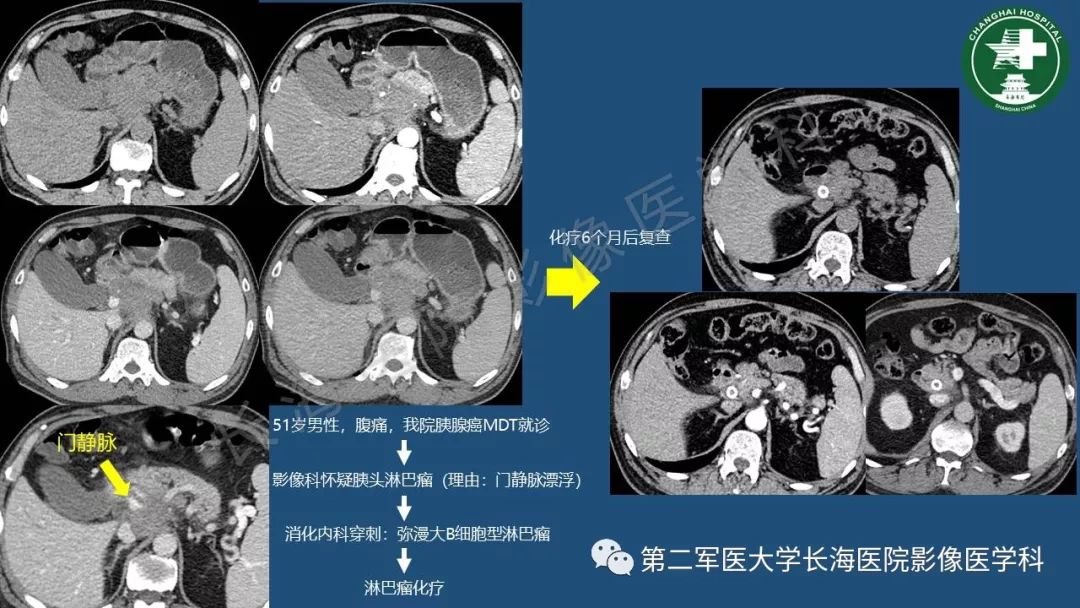 影像PPT - 【PPT】胰腺影像诊断在临床决策中的意义及常见误诊病种-12