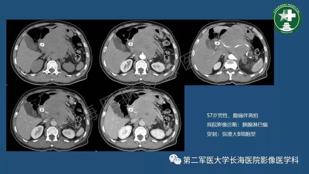 影像PPT - 【PPT】胰腺影像诊断在临床决策中的意义及常见误诊病种-11