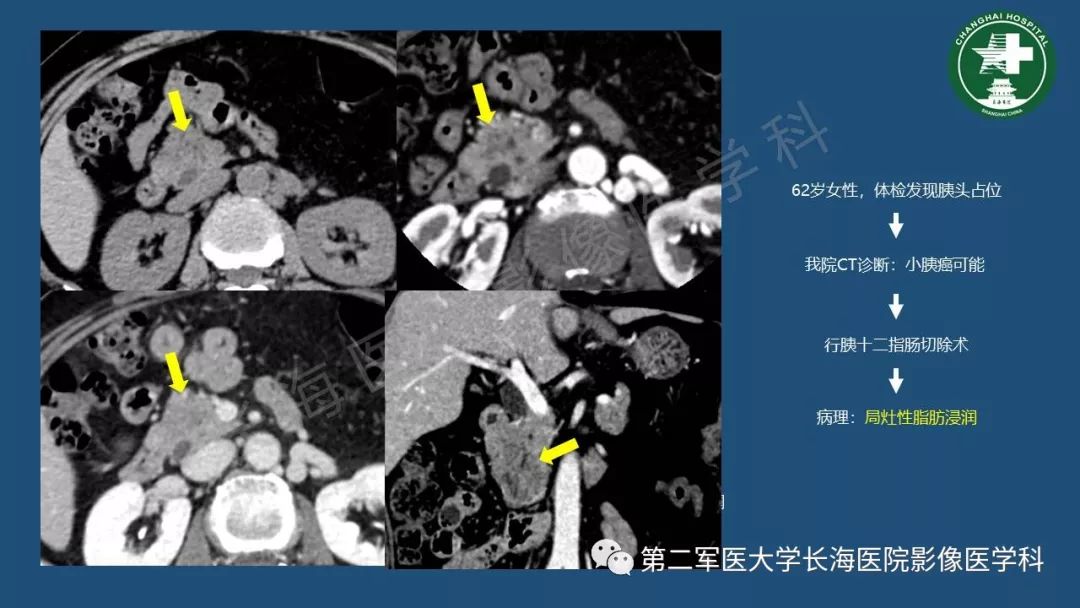 影像PPT - 【PPT】胰腺影像诊断在临床决策中的意义及常见误诊病种-14