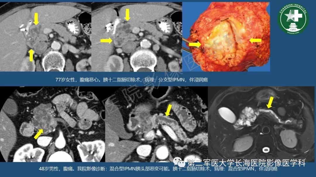 影像PPT - 【PPT】胰腺影像诊断在临床决策中的意义及常见误诊病种-19