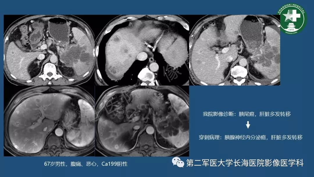 影像PPT - 【PPT】胰腺影像诊断在临床决策中的意义及常见误诊病种-21