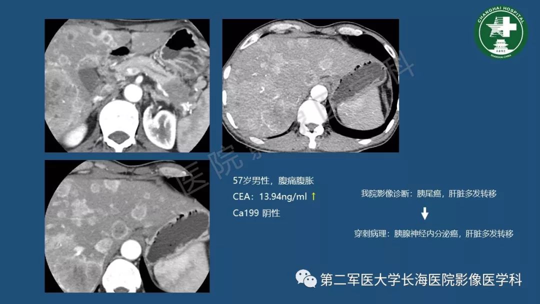 影像PPT - 【PPT】胰腺影像诊断在临床决策中的意义及常见误诊病种-22
