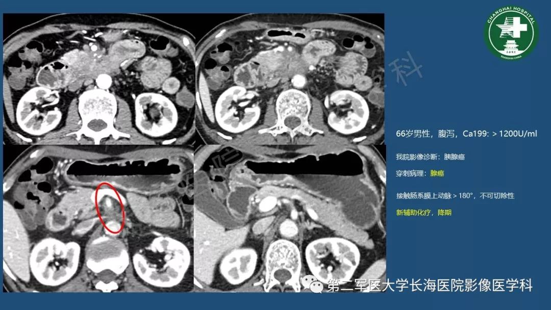 影像PPT - 【PPT】胰腺影像诊断在临床决策中的意义及常见误诊病种-26