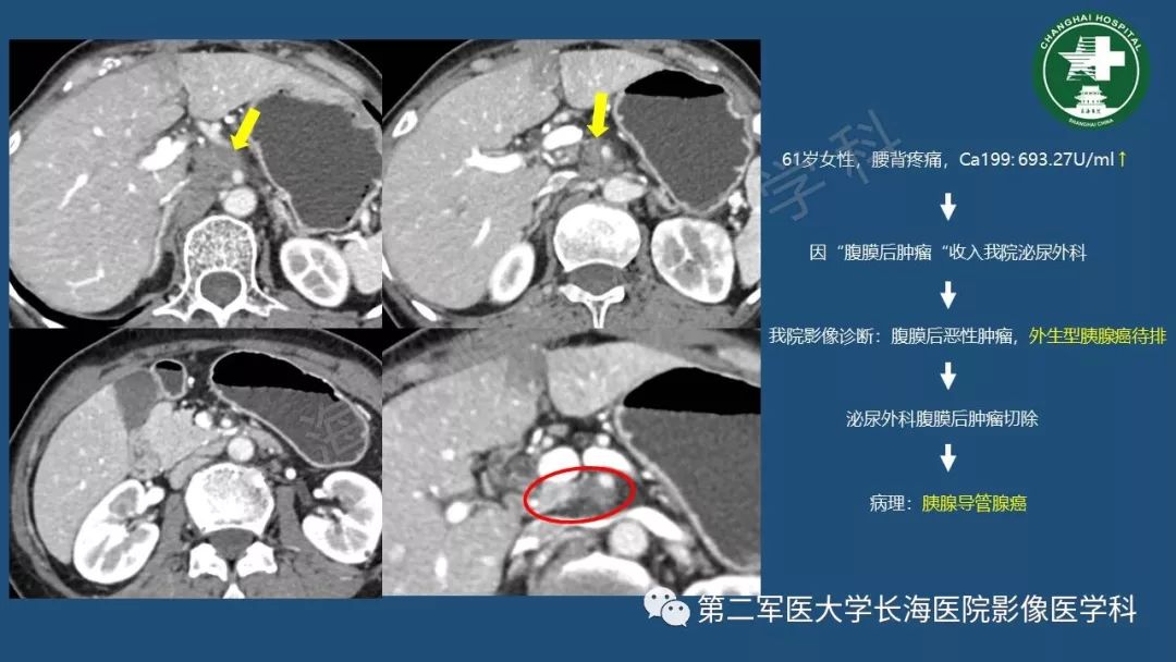 影像PPT - 【PPT】胰腺影像诊断在临床决策中的意义及常见误诊病种-24