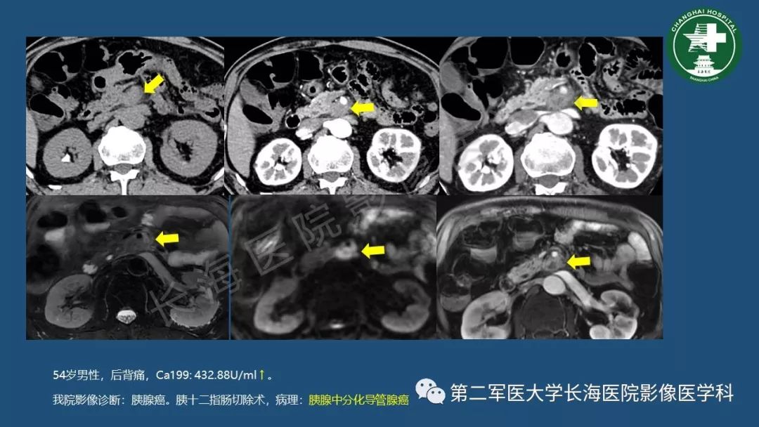 影像PPT - 【PPT】胰腺影像诊断在临床决策中的意义及常见误诊病种-25