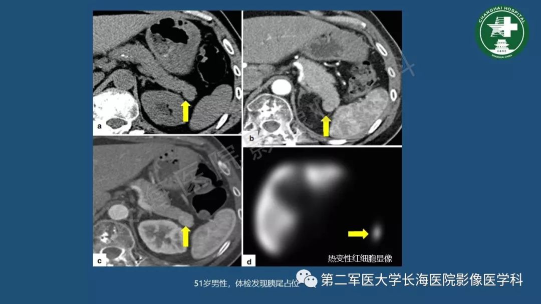 影像PPT - 【PPT】胰腺影像诊断在临床决策中的意义及常见误诊病种-31