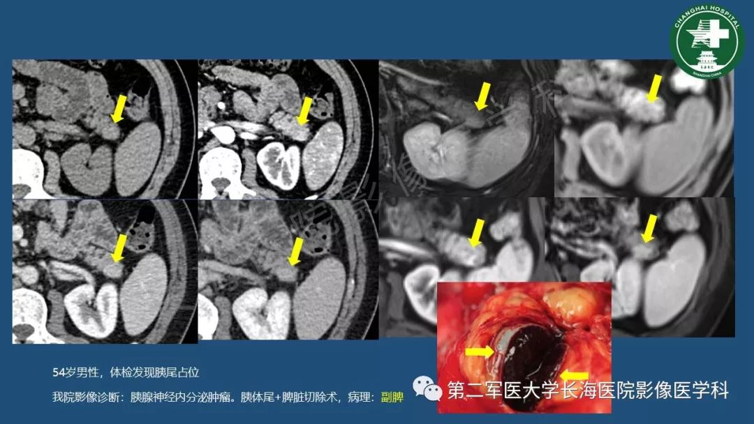 影像PPT - 【PPT】胰腺影像诊断在临床决策中的意义及常见误诊病种-30